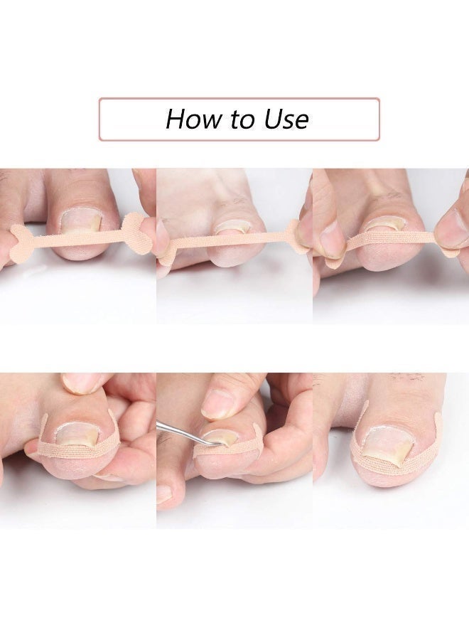 Peachjoy 52pcs Ingrown Toenail Treatment, Ingrown Toenail Corrector Patches, Health Toenail Correction Stickers, Professional Glue-Free Toe Nail Treatment Tool, Foot care - Image 3